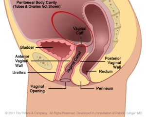 How to enjoy life after endometrial cancer and hysterectomy